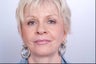 Juvederm Injection