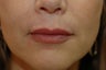 Juvederm