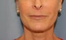 Juvederm injection