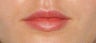 Juvederm in the Lips