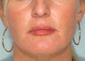 Juvederm in the Lips