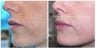 Juvederm: Subtle Lip Enhancement