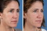 Juvederm Ultra, Restylane & Dysport