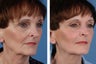 Juvederm Plus
