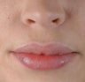 Lip Injection