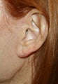 Earlobe filler