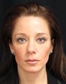 Facial balancing and reversal of early aging changes with Juvederm Ultra Plus XC