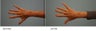 Juvederm to hands