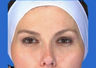 Juvederm
