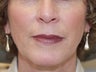 Juvederm