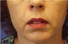 Juvederm