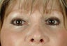 under eye fillers