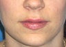 Juvederm Lip Enhancement