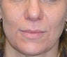 Volume Filler to Nasolabial Folds and Eye region