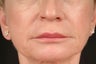 Juvederm Injectable Filler