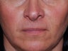 Juvederm