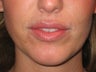 Juvederm