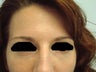 Under Eye Filler Treatment
