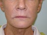 Facelift In A Syringe