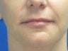 Juvederm chin and lip enhancement