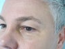 Undereye Filler Treatment