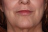 Juvederm Lip Enhancement