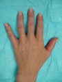 Filler & IPL Before