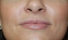 Juvederm Lip Augmentation
