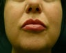 Juvederm Lip Augmentation