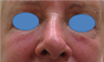 Juvederm Filler for lower eyelid hollows