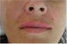 Juvederm for upper lip and nasolabial folds