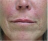 Juvederm to the upper lip