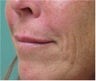 Juvederm to Upper Lip
