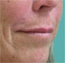 Juvederm to the upper lip