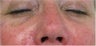 Juvederm for lower eyelid hollows