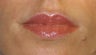 Juvederm Lip Augmentation