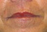 Juvederm effacement of perioral lines