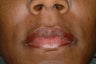 Juvederm