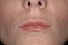 Juvederm Ultra