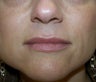 Juvederm