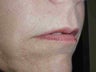 Juvederm to upper lip
