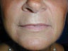 Juvederm to upper lip