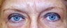 Botox and Juvederm to glabellar lines