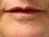 Lip Augmentation