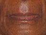 Lip augmentation with juvederm