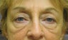 Filler for under eye hollows (IOH)