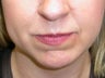 Fillers