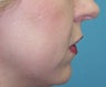 Fillers