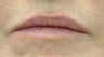 Juvederm and Botox to lips