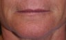Juvederm filler to the lips
